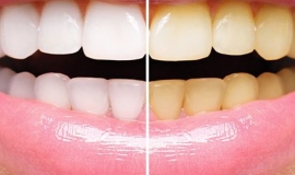Hydrogen Peroxide Teeth Whitening Natural Remedy: Does It Function?