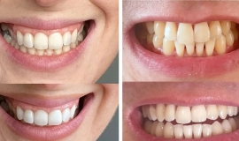 Advantages Of Non-peroxide Teeth Whitening