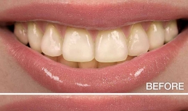Teeth Whitening Overview: Quick & Secure Options