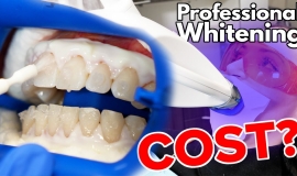 How Long Do Teeth Whitening Results Usually Last?