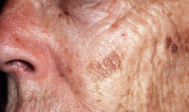 Understanding The Difference Between Precancerous Skin Growths And Skin Cancer