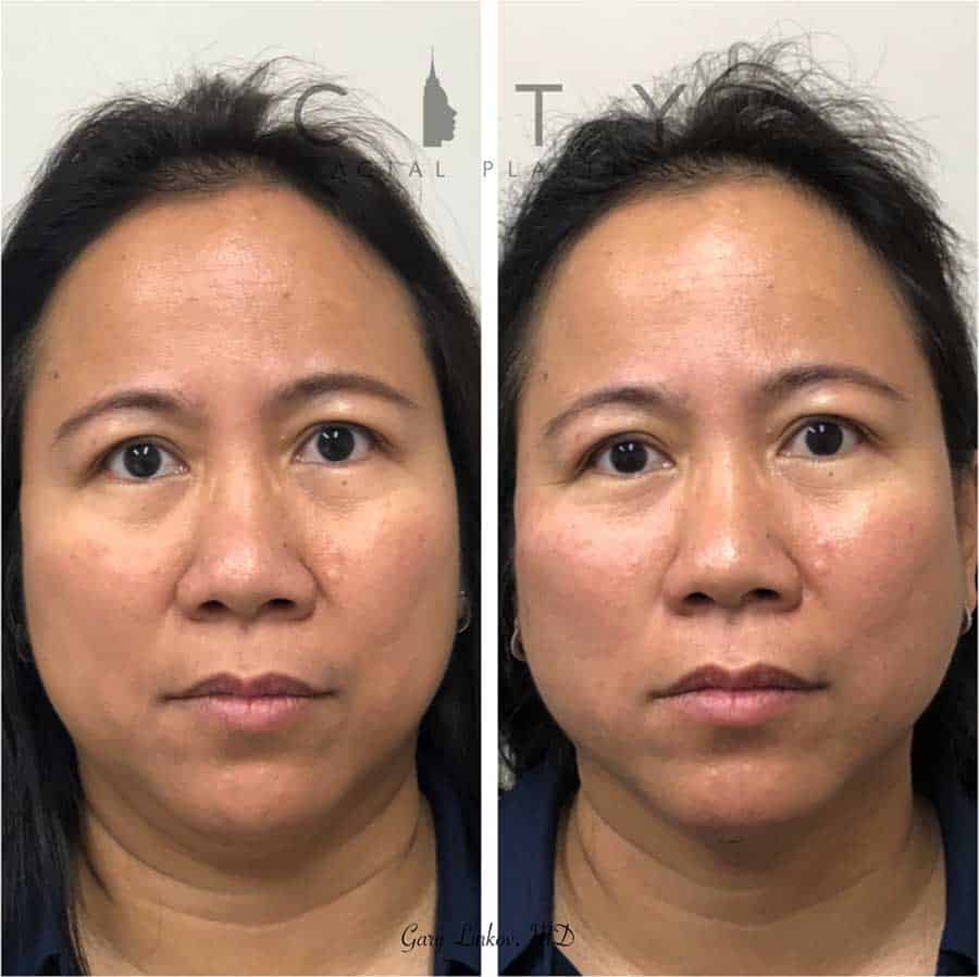 Fat Cold What Outcomes To Expect With Coolsculpting