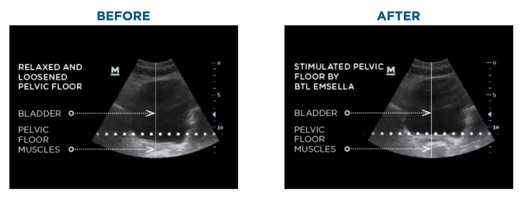 Coolsculpting Healing: What To Expect After Treatment