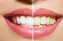 Expert Teeth Whitening In Mcallen, Tx