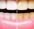 Hydrogen Peroxide Teeth Whitening Natural Remedy: Does It Function?