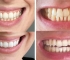 Advantages Of Non-peroxide Teeth Whitening