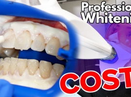 How Long Do Teeth Whitening Results Usually Last?