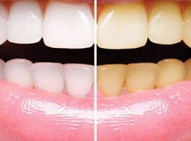 Hydrogen Peroxide Teeth Whitening Natural Remedy: Does It Function?