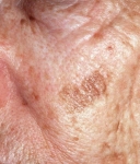 Understanding The Difference Between Precancerous Skin Growths And Skin Cancer