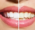 Expert Teeth Whitening In Mcallen, Tx