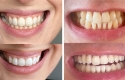 Advantages Of Non-peroxide Teeth Whitening