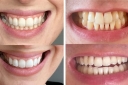 Advantages Of Non-peroxide Teeth Whitening