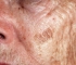 Understanding The Difference Between Precancerous Skin Growths And Skin Cancer