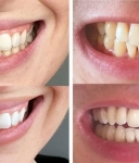 Advantages Of Non-peroxide Teeth Whitening