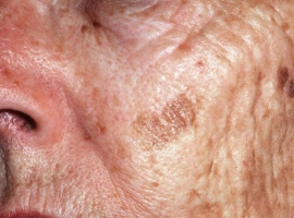 Understanding The Difference Between Precancerous Skin Growths And Skin Cancer