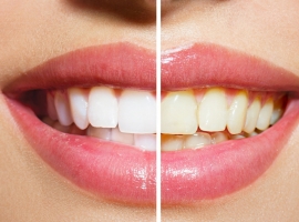 Expert Teeth Whitening In Mcallen, Tx