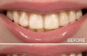 Teeth Whitening Overview: Quick & Secure Options