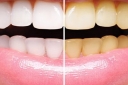 Hydrogen Peroxide Teeth Whitening Natural Remedy: Does It Function?
