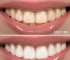 Teeth Whitening Overview: Quick & Secure Options