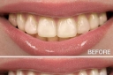 Teeth Whitening Overview: Quick & Secure Options