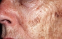Understanding The Difference Between Precancerous Skin Growths And Skin Cancer