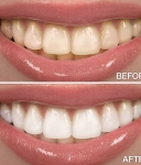 Teeth Whitening Overview: Quick & Secure Options