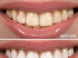 Teeth Whitening Overview: Quick & Secure Options