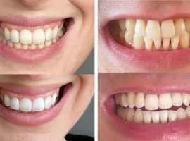 Advantages Of Non-peroxide Teeth Whitening