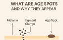 Skin Tags Causes And Therapy
