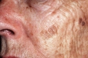 Understanding The Difference Between Precancerous Skin Growths And Skin Cancer