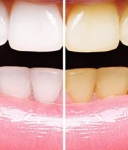 Hydrogen Peroxide Teeth Whitening Natural Remedy: Does It Function?